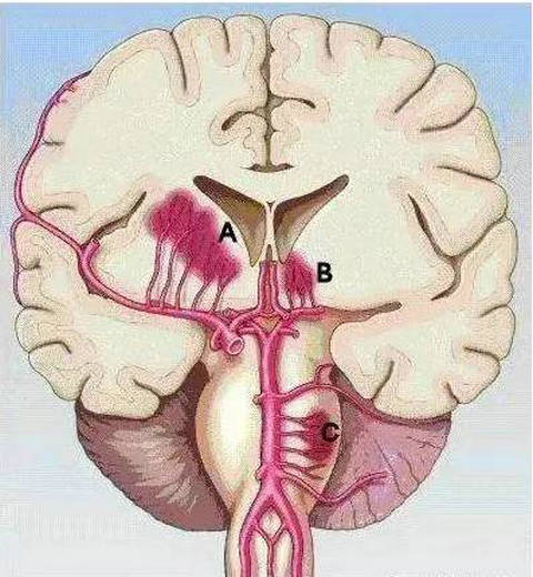 脑血管堵塞的7个身体反应,你一定要知道!