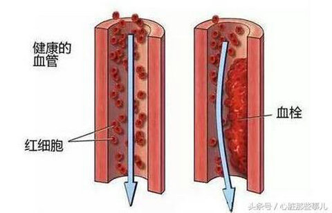  10个信号一出现，小心体内藏血栓！绝不容忽视！