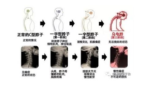 颈椎酸疼难忍，一个小动作就能治，关键还能降血压